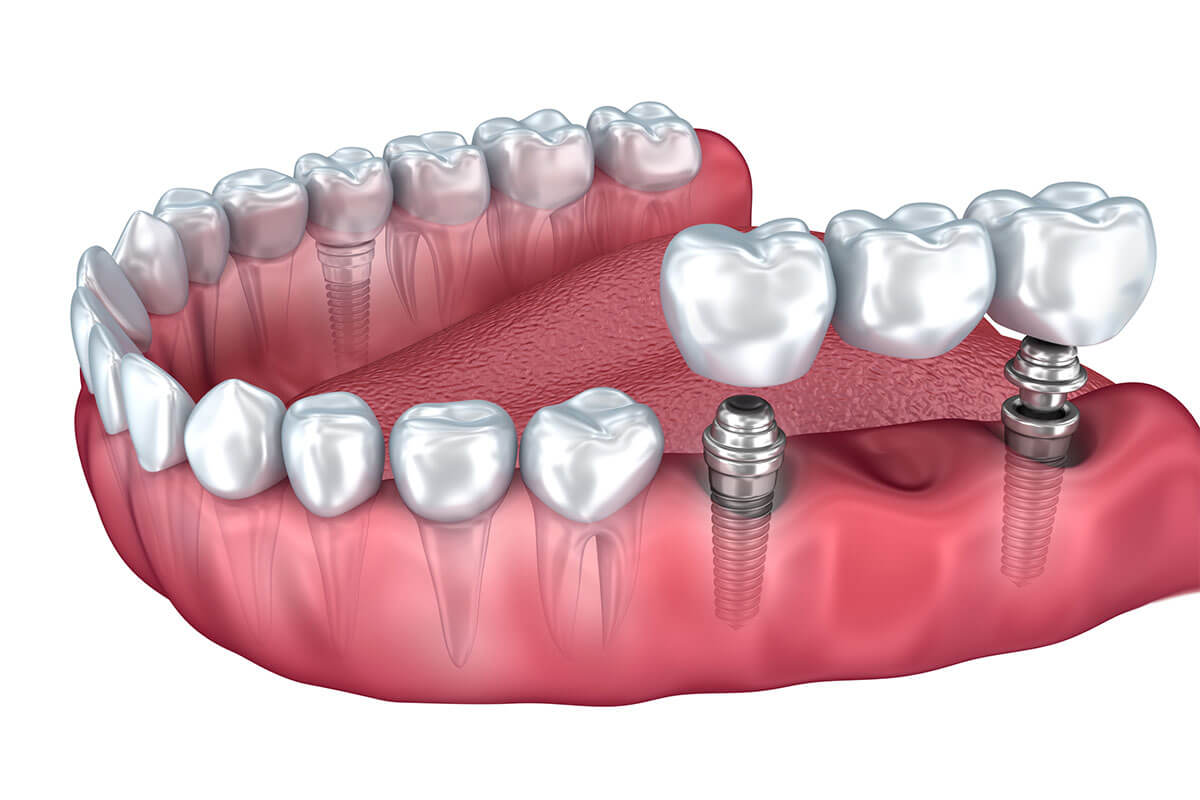 Are there any restrictions on eating or drinking after dental implant surgery?